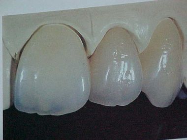 provall-ceramica-dientes